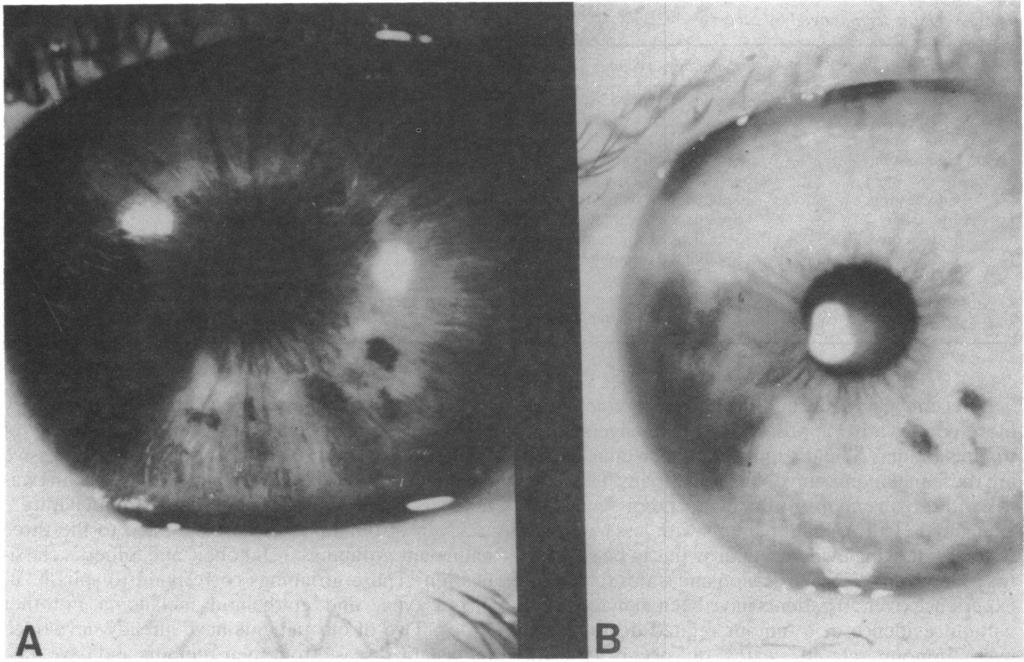 A study ofiris melanoma in Northern Ireland Fig. 2 Nasally located melanoma showing evidence ofgrowth. Photographs taken 18 months apart. A: August 1984. B: February 1986.