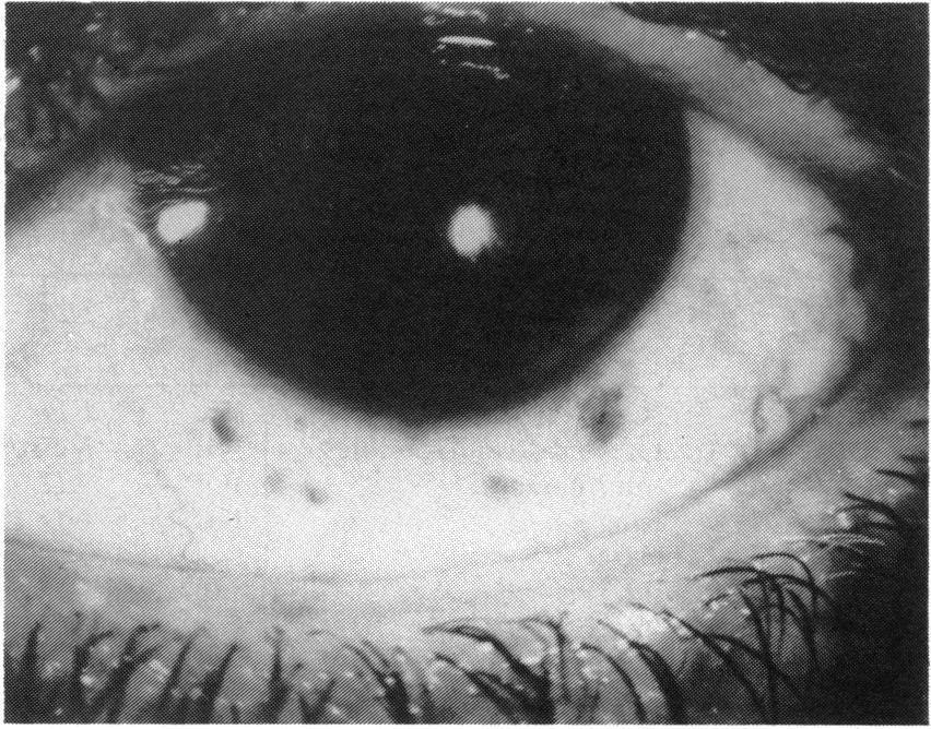 face of ciliary body, no Died 5 years 9 months after surgery, liver extrascleral spread metastases 4 Enucleation Spindle B Confined to iris, no extrascleral spread Three years, well 5 Iridectomy