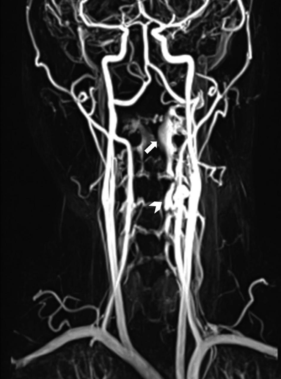 Pulsatile Tinnitus with Prominent Venous Plexus Jung H, et al. cular abnormality such as arteriovenous fistula (Fig. 5).