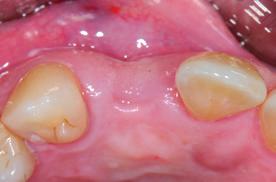 17 Fig. 4: From the incisal approach there appears to be a soft tissue and bone defect. Fig. 5 and 6: Photograph of the implant region.