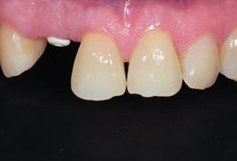 Transgingival healing Even though subgingival healing is also possible with the isy Implant System, we almost always prefer