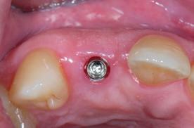 We know from the literature that a transgingival approach in the esthetic zone has no drawbacks, even with moderate bone