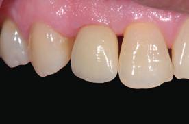 23: When the gingiva former was removed,
