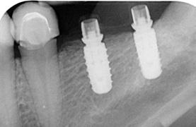 20 Fig. 34: Second case study: Insertion of two isy implants with diameter of 4.4 mm, length 11 mm. Fig. 35: Situation after two months transgingival healing. Fig. 36: Occlusal view of the implant bases.