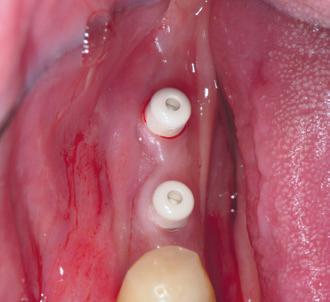 The screw channel was sealed with a filling composite. Fig. 43: The clinical result immediately after the placement.
