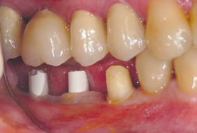 Clin Oral Implants Res. 2013 Oct;24(10):1130-6. [2] Becker K, Mihatovic I, Golubovic V, Schwarz F.