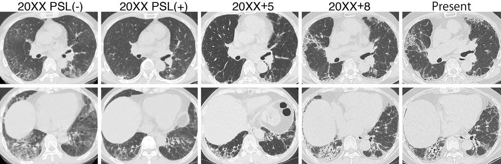 Figure 2. Computed tomography images since the initial admission. Reticular shadows decreased after the administration of PSL in 20XX and clearly reappeared with traction bronchiectasis in 20XX+8.