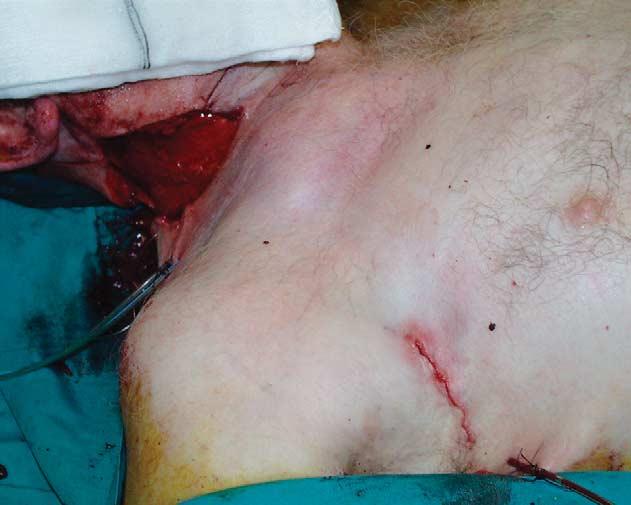 Endoscopic assisted harvesting of the pedicled PMM flap was performed through an infra mammary approach allowing simultaneous flap harvest and tumour resection.