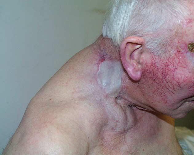 Case 2 An 83 year old male presented with a recurrent squamous cell carcinoma on the right side of the neck. This was treated with radiotherapy 7 years previously (Fig. 5).