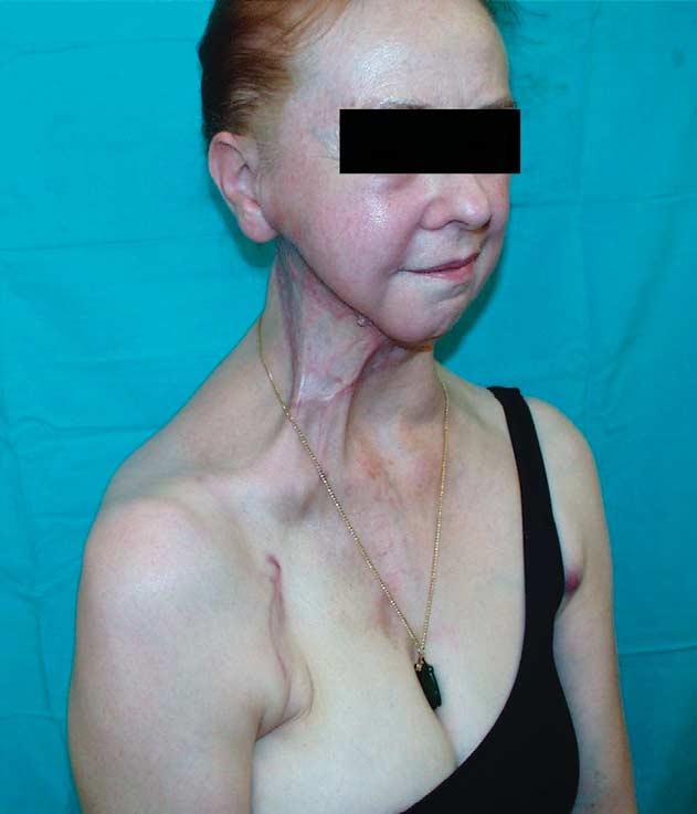 Traditional incision for PMM harvest leaves a cosmetically poor site defect, particularly on the female anterior chest wall.