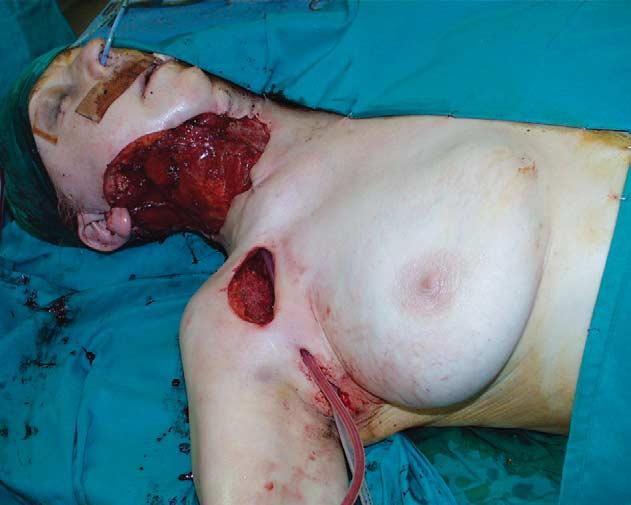Post-operatively, patients did not complain of donor site pain but they complained of discomfort on the chest wall.