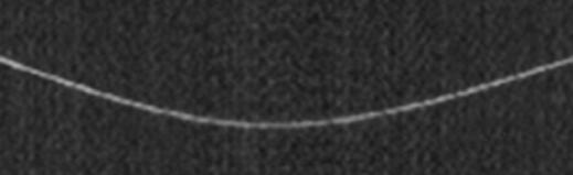 and, Phantom minor fissure is visualized as thin line with no and mild stairstep artifact on sagittal images using 0.5-mm collimation at pitch of 1 () and 1.5 ().