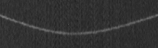 E H, Phantom minor fissure is visualized as significantly thick line on images obtained with 2-mm collimation at ptich of 1 (E) and 1.