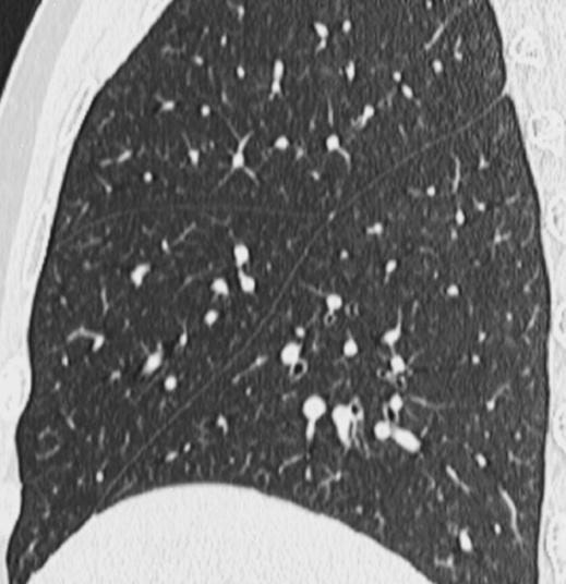 Normal Pulmonary Fissures on MDCT Fig.