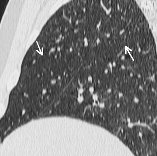 blurred line (arrows). C, Image obtained using 2-mm collimation at pitch of 1.