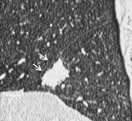 , Sagittal multiplanar reconstruction (MPR) image obtained using 1-mm collimation at pitch of 1.