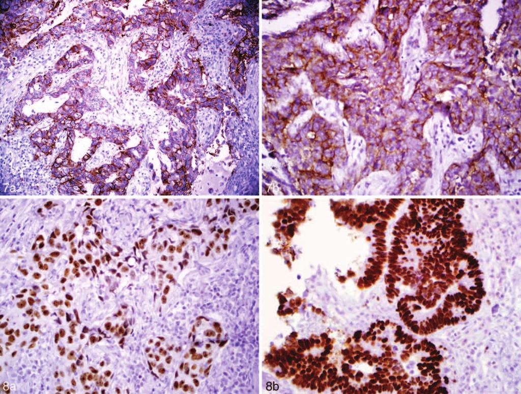 Figure 7. a, Metastatic lung exhibiting positivity for MOC31. b, Squamous cell carcinoma (SCC) exhibiting positivity for Ber-EP4 (immunohistochemistry, original magnification 340 [a and b]). Figure 8.
