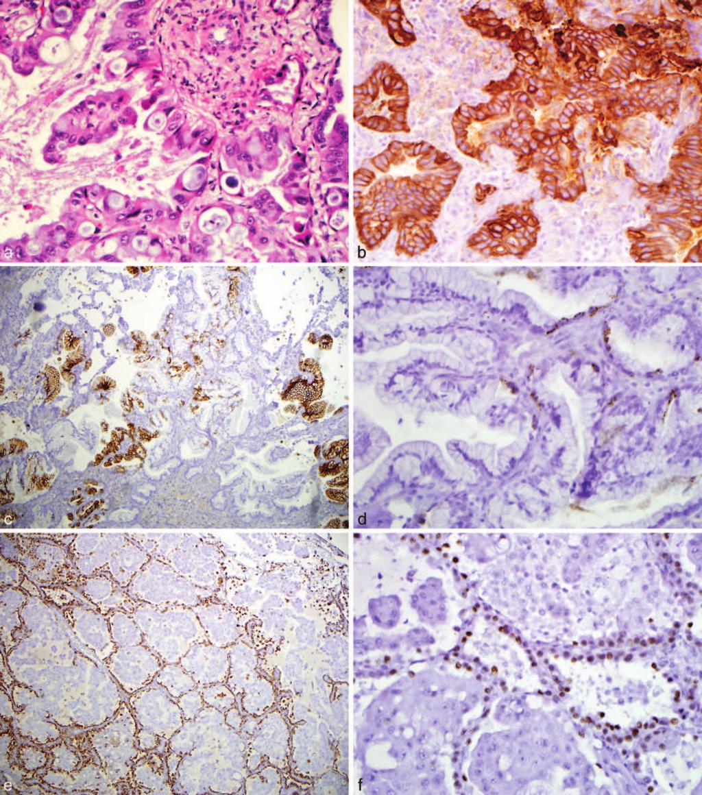 Figure 2. a, Hematoxylin-eosin stained section of invasive mucinous adenocarcinoma (IMA) with proliferating tall columnar with some scattered goblet cells.