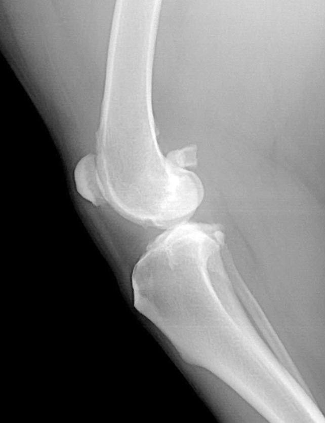 Figure 2-5 In this radiograph the lateral femoral condyle appears to be more distal (closer to the tibia) than the medial condyle.