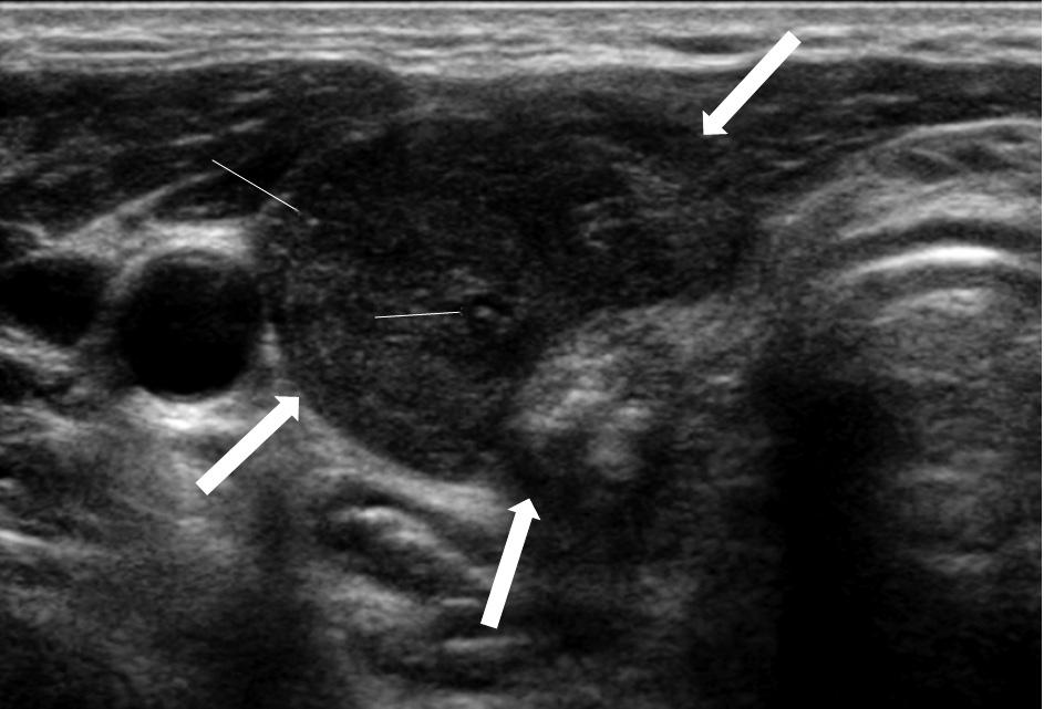 Columnar Cell Variant of PTC Table 2. Ultrasonographic Features of Six CCVs-PTC Case Age/sex US Size (cm) Internal Content Echogenicity Margin Orientation Shape Calcification 1 34/F 1.