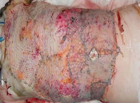 DISSCUTION AND CONCLUSION Temporary alternative cover in massive burn injury, use as biological dressing, promotes