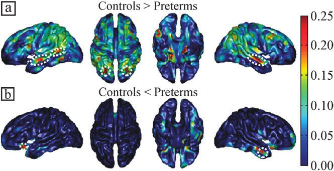 Cortical Thickness at