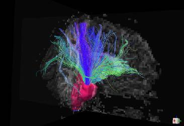 Connectivity assessment by MRI With tractography