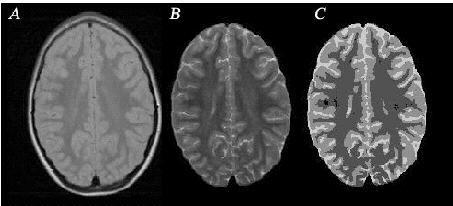 Long term alteration of grey matter development at 8 years in preterms 3D-MRI