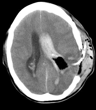 intracerebral haemorrhages. Patients were classified by Kanaya system in admission.