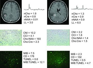 Glioma growth and MR spectroscopic characteristics FIG. 2.