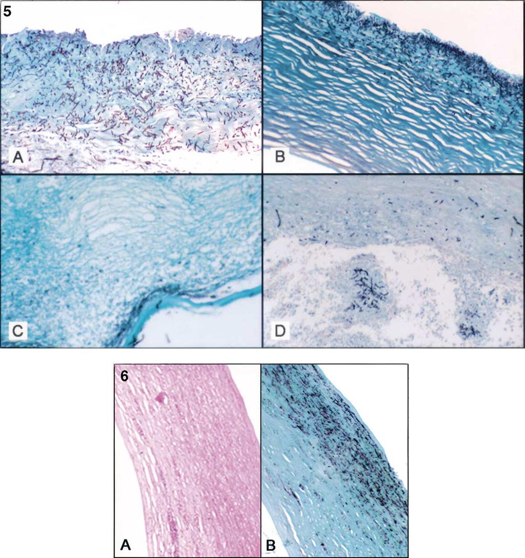 Vemuganti et al Mycotic Keratitis A Histologic Study Figure 5.