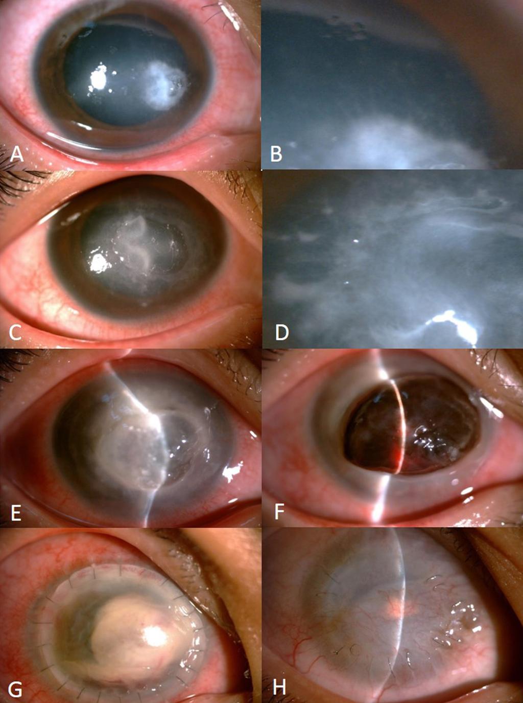 A B C D E F G H Figure 1. (A) Slit-lamp photograph shows a 2 3 mm 2 nasal peripheral corneal white stromal ulcer surrounded by diffuse infiltration.