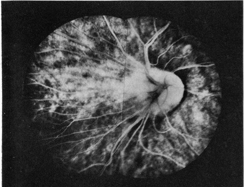 Fig. 2 Fluorescein angiogram of case 1, showing distortion of the right eye central retinal vessels. and leakage into the macula area. Hospital on 10 October 1977.