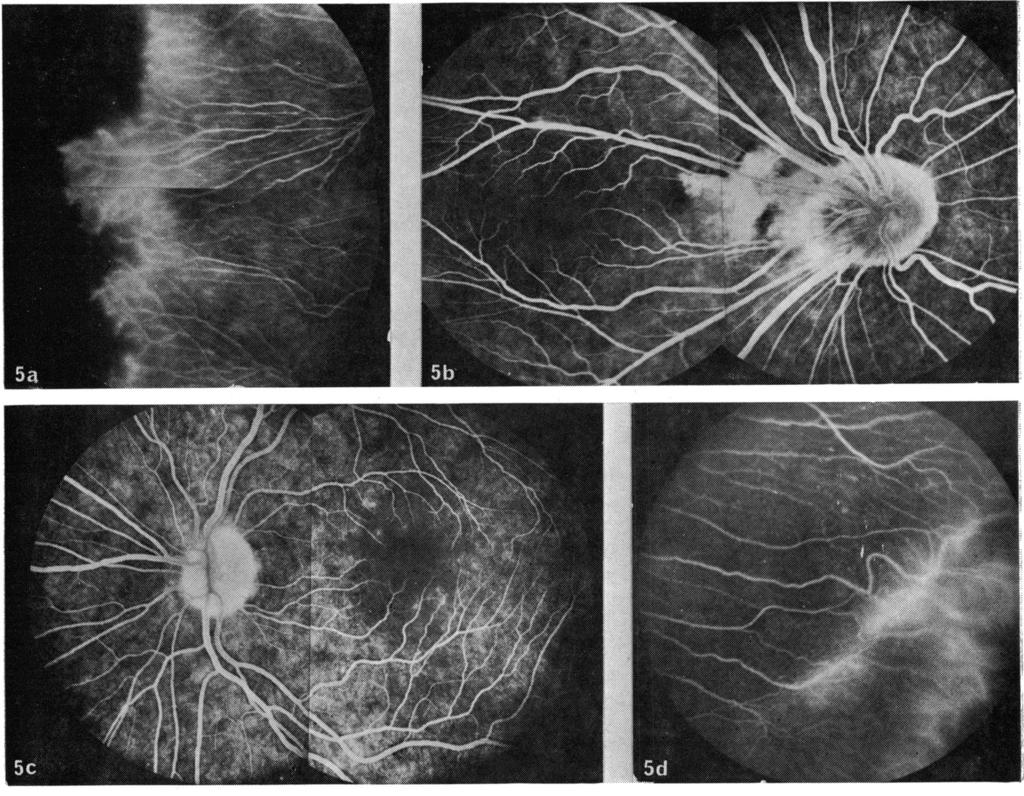 Fig. 5 Fluorescein angiogram in case 5, showing distortion of the central retinal vessels in the right eye only (5b), peripheral retinal vessel closure with leakage (5a, d) and leakage from the