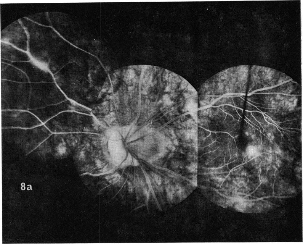 118 Fig. 8 Fluorescein angiogram of case 11, showing distortion of the central retinal vessels with leakage and dye in the macular region and from a nasal retinal vein (a).