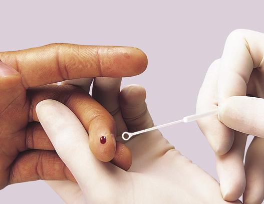 Using a sterile lancet, puncture the skin just off the center of the finger pad. Hold the finger downward. Apply gentle pressure beside the point of the puncture.