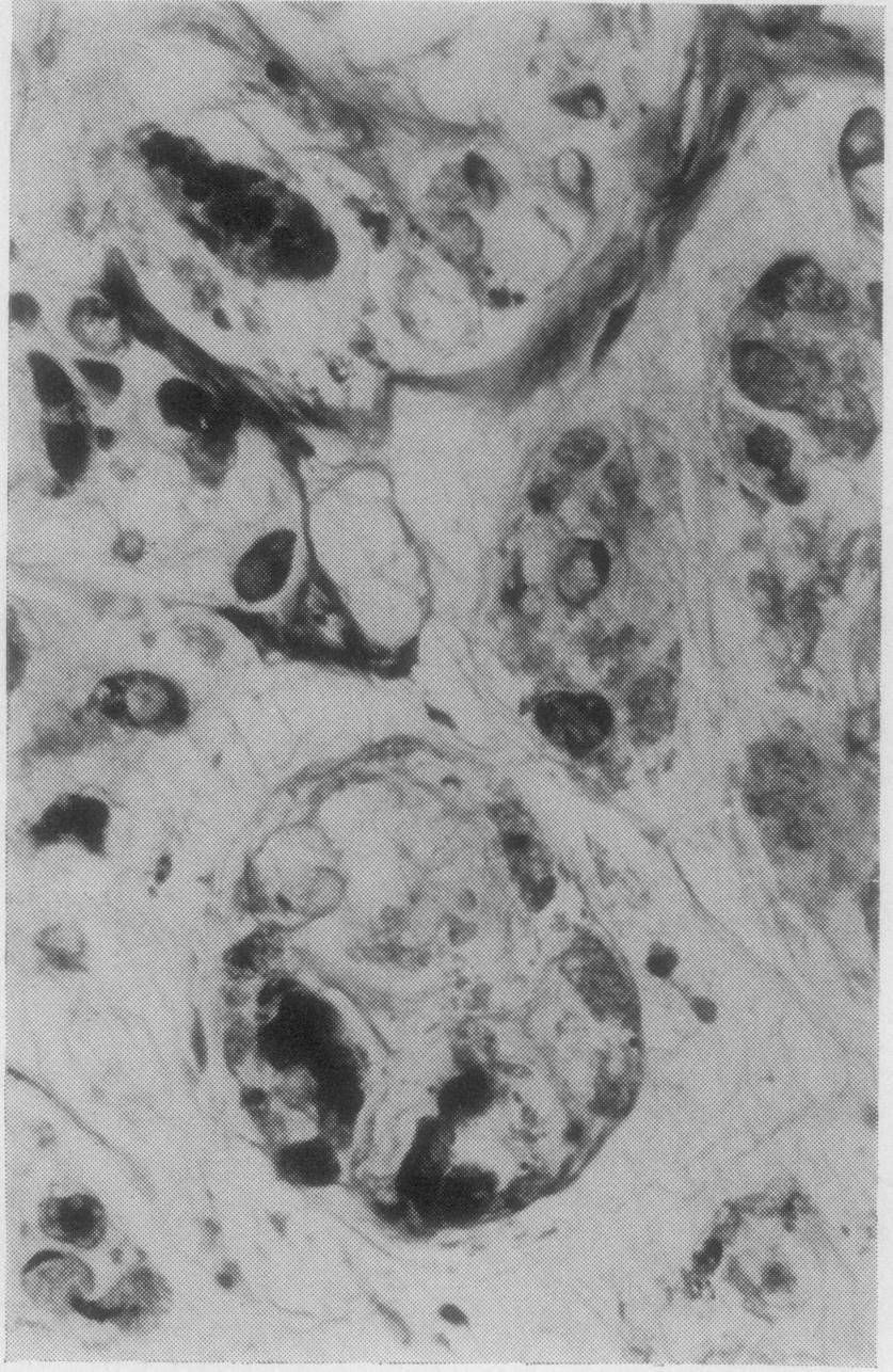 538 Fig 4 High-power view of tumour seen in fig 3, with tumour cells floating in mucus showing some of the cytological appearances described in the text. HE x 500. types.