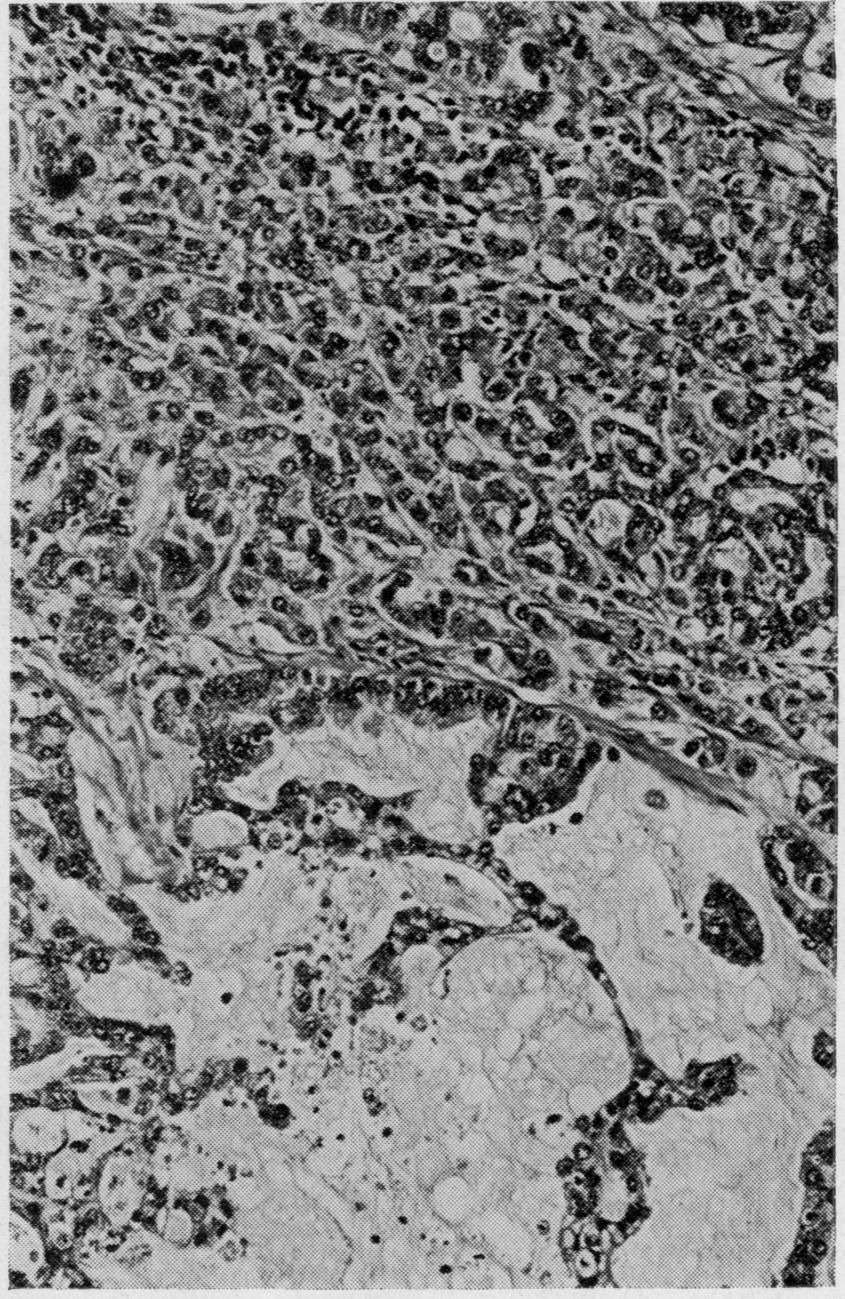 Indolent mucoid carcinoma of stomach Fig 6 Fig 7 Fig 6 Mucoid carcinoma of indolent type showing masses of extracellular mucin indenting gastric muscle.