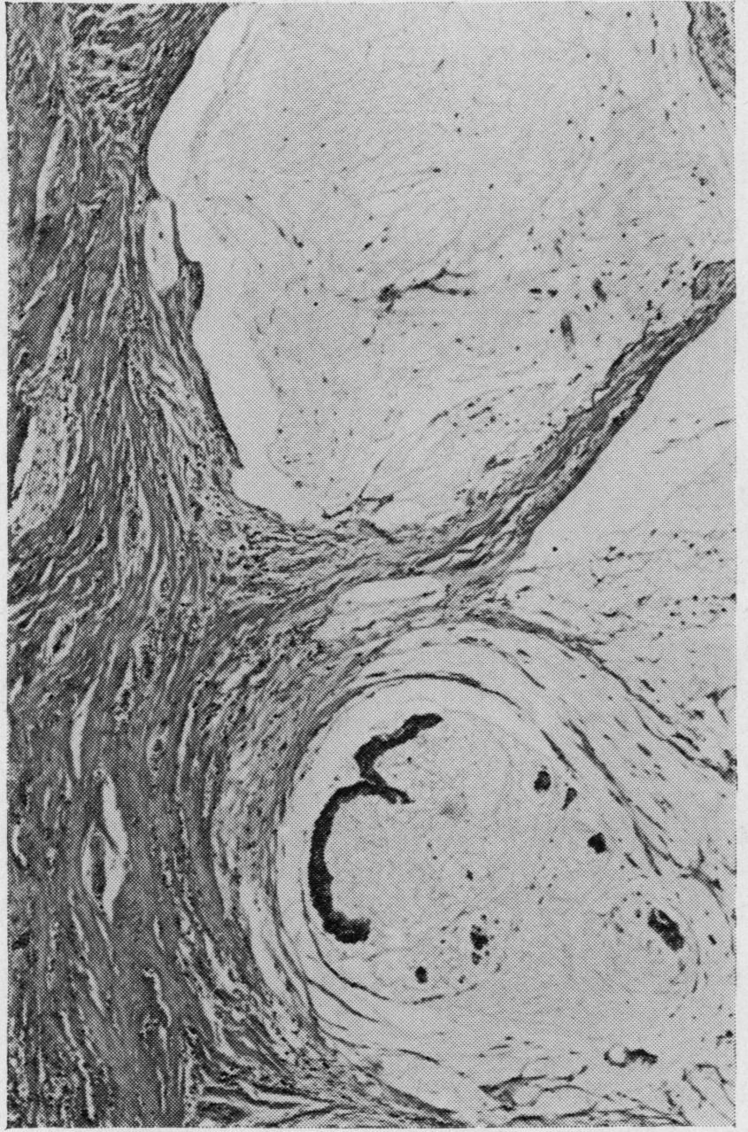 Fig 7 Mucoid carcinoma of 'mixed' type, with much extracellular mucus in some areas but showing transition to a more cellular growth pattern. HE x 125.