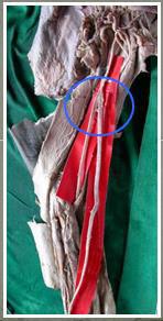 Anterior interosseous artery was large in size.