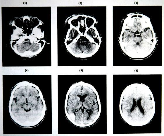 Study of the Living Human Brain Computerized Tomography A lesion in the right occipitalparietal area (scan 5) is evident with white area