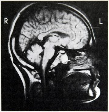 Study of the Living Human Brain Magnetic Resonance Imaging (MRI) The MRI scanner resembles a CT scanner, but it does not use X-rays; instead, it passes an extremely strong magnetic field through the