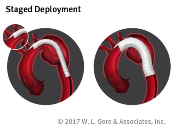 GORE ACTIVE CONTROL System Active positioning of the stent graft for