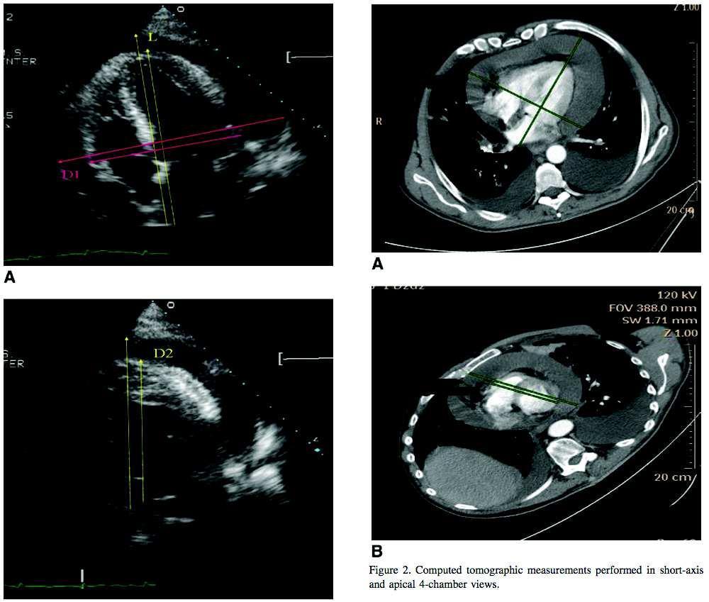 Quantification of Pericardial Effusions by Echocardiography and Computed Tomography