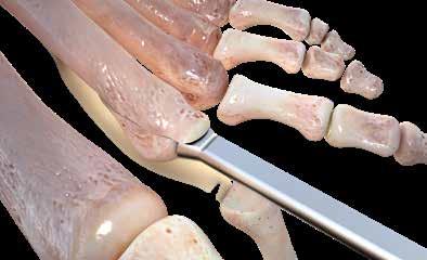Step 2: Distal Metatarsal Osteotomy A distal metatarsal osteotomy is performed to increase the working area and to shorten the metatarsal.
