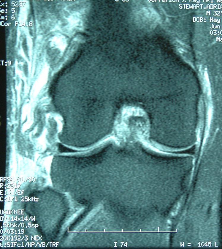 Posterolateral Corner Injuries of the Knee: Pearls and Pitfalls Robert