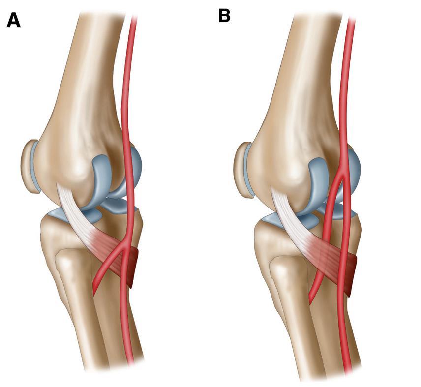 Popliteal Artery Normal bifurcation: at inferior margin of popliteus muscle High division: above the middle of posterior surface of popliteus muscle Aberrant course ventral to popliteus muscle is