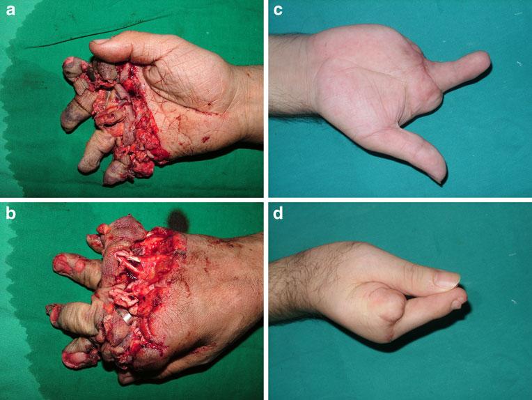 c Late postoperative view of the hand considered as a case of HDR (fifth finger replanted proximally to its normal position in the receptive metacarpal region) since it has been replanted proximally