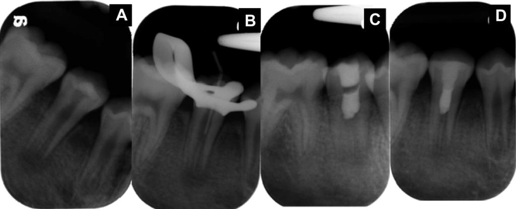 Immature teeth treated with triple antibiotic paste 197 closed by traditional apexification or artificial apical barriers, the apexification technique does not promote thickening of the root wall or
