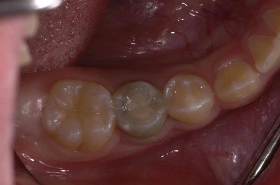 198 H.-J. Wang et al Figure 2 Clinical photograph showing that buccal vestibule swelling at tooth 29 had subsided and there was discoloration 21 days after triple antibiotic paste placement.